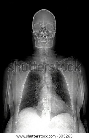 This is a real MRI (Magnetic Resonance Image) of a man, showing the head, shoulders, lungs,thoracic cavity, arms, and heart.