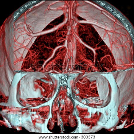 A real MRI/ MRA (Magnetic Resonance Angiogram) of the brain vasculature (arteries).  This MRI study is  often used to show/find brain aneurysms.