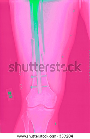 A real x ray, colorized, of a repaired femur fracture after a motorcycle accident.  The repair is held in place with a rod and IM (intramedullary) nails.