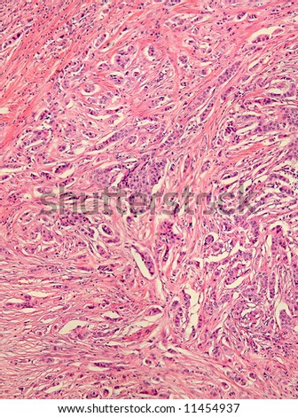 Real photomicrograph of breast adenocarcinoma. Panorama of a slide under the microscope. Some areas will be blurry due to the nature of the tissue.