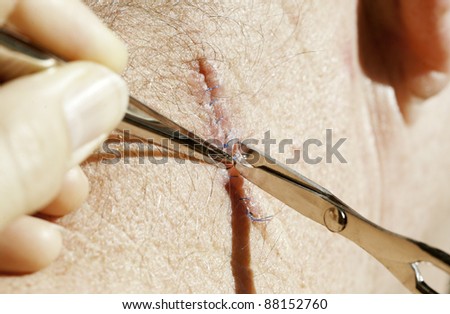 A doctor removes blue suture stitches from a healing wide local excision on the neck for basal cell cancer using a suture removal kit.