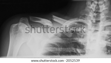 broken clavicle cast