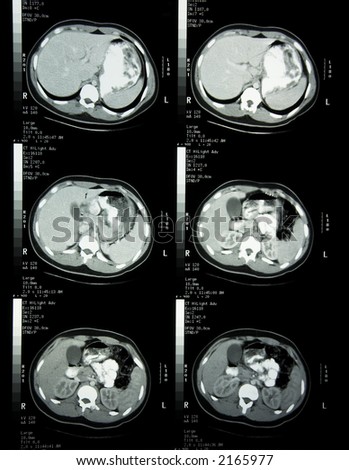 Pancreas, or anywhere along liver pancreas gallbladder anatomy. Pancreas, or anywhere along
