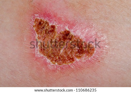 Second degree burn of an arm of a man healing