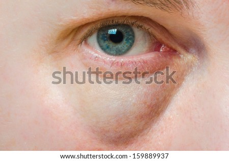 Puffy swollen eye on a Caucasian person