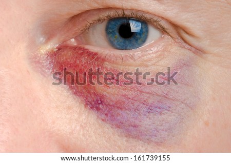 Black eye on a caucasian man close up