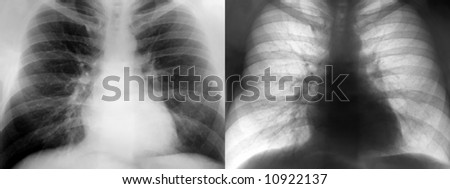 Comparing a Positive and Negative Chest Xray.