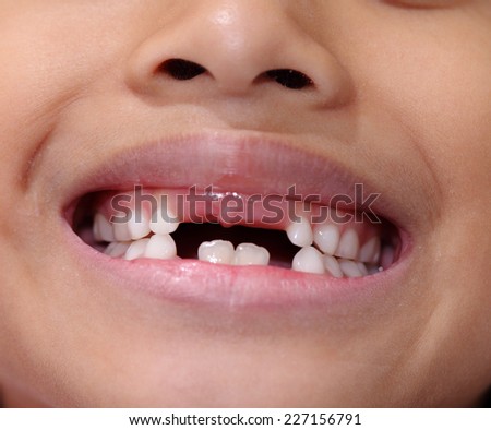 Asian young girl with missing front tooth.