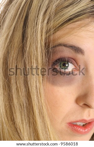 black eye bruised woman