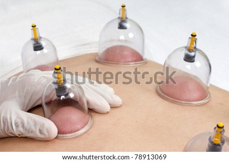 Multiple vacuum cup of medical cupping therapy on human body