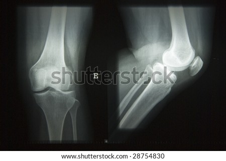 X-Ray picture of knees front and side view