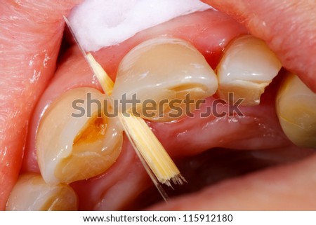 A broken tooth \'s treatment with composite filling material - first steps.