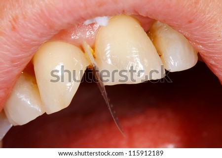 A broken tooth \'s treatment with composite filling material - first steps.