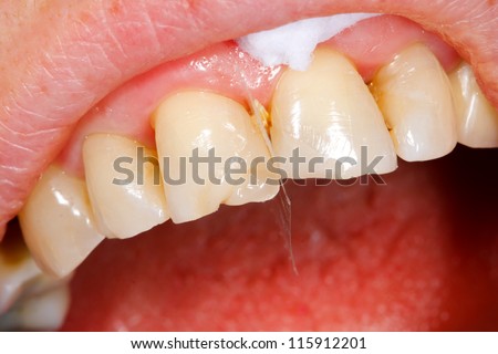 A broken tooth \'s treatment with composite filling material - almost finished.