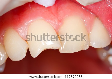 Fractured human teeth needing medical attention - the treatment is documented in my portfolio.