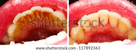 Two photos made by dentist, one before and one after the treatment of dental tartar - the subsidence is the result of residual food, smoking and coffee drinking - part of Beforeafter series.
