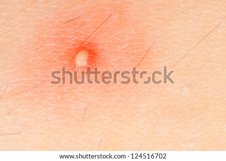 A macro shot of an inflamed zit on skin.