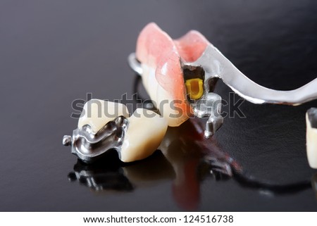 Part of a skeletal prosthesis that replaces missing teeth through special clamping systems and it can be removed by the patient - part of a series.