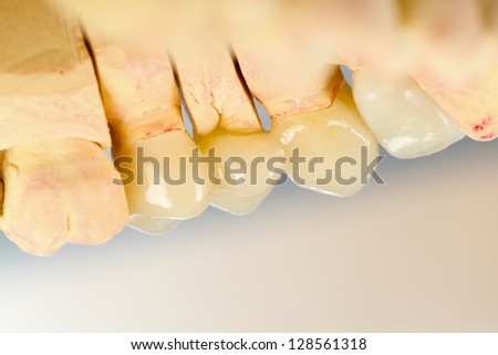 The inner view of a highly aesthetic dental bridge and crown on gypsum model.