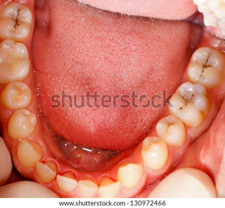 Human teeth with cavity needing treatment photographed from a rare angle.