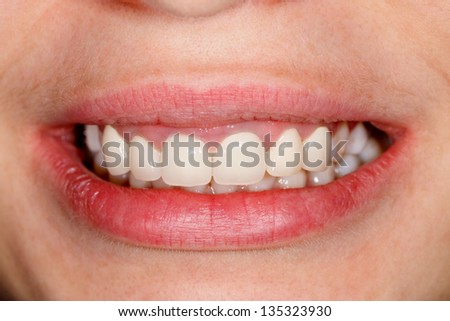 Beautiful teeth of a young woman - dental prosthetics - entirely documented treatment.