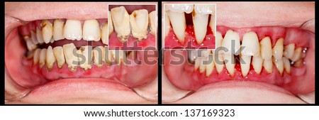 Human denture on dental treatment