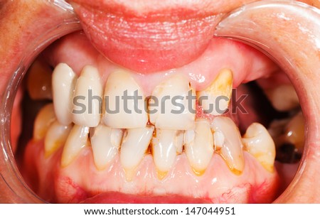 Picture of human teeth during dental treatment.