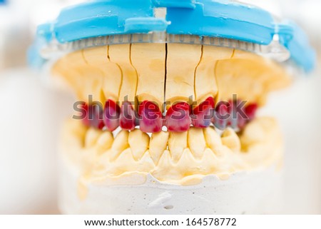 A functional closeup of two dental prosthesis, a total and a partial skeletal prosthesis.