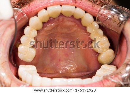 Entire upper dental teeth bridge in patient\'s mouth.