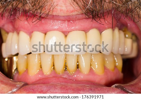 Entire upper dental teeth bridge in patient\'s mouth.