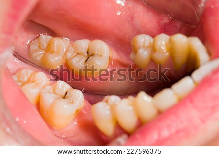 Simple cavity between healthy teeth in mouth.