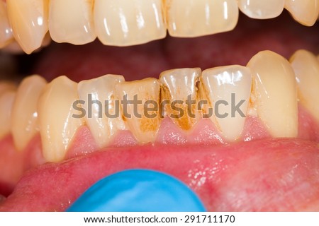 Dental plaque on denture, sign of smoking habits.