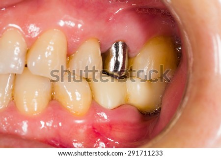Dental probe for porcelain tooth on metal bases.