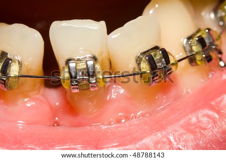 teeth braces. shot of dental braces,