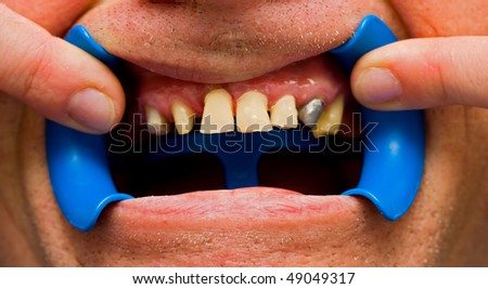 Scutan crowns for temporary crown treatment, that are used in cases when the patient has to walk away with buffed teeth from the dentist, protective role on teeth,  with less regard on aestetics.