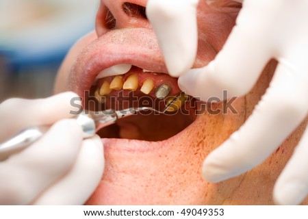 A dentist placing a retraction thread in the dental sulcus before taking imprint. Blood and crevicular fluid can be controlled by these cords. Is critical for fine imprinting while taking impression.