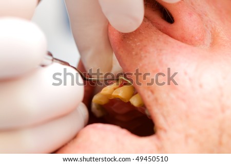 A dentist placing a retraction thread / yarn in the dental sulcus before taking imprint Is critical for fine imprinting while taking impression - series.