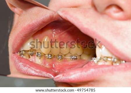 teeth braces colors. shot of dental braces,