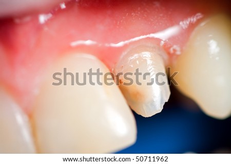 A macro shot of a discolored tooth after root canal treatment with secondary caries next to the filling, the patient came for help to the dentist, the prosthetic treatment is in my portfolio.