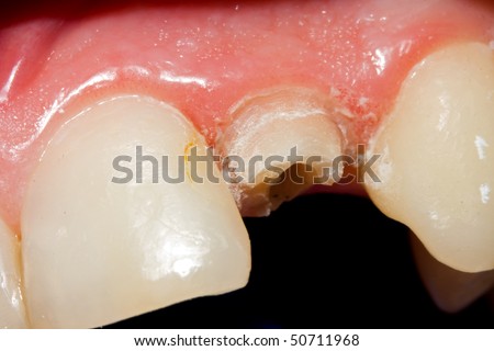 A fractured tooth because of insufficient dental material after buffing - the treatment in my portfolio.
