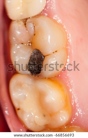 A photograph with the posterior upper molar teeth, cavities, gingival affection, fillings, massive plaque deposits and tartar - taken with a special photography tehnique, with dental mirrors.