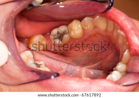 A photograph with the posterior lower molar teeth, one premolar with crown, cavities, fillings and plaque deposits - taken with a special photography technique, with dental mirror.