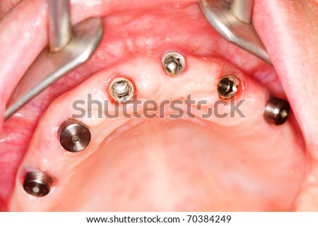 A macro shot of dental implants in the oral cavity (human mouth) - gingival cuffs are being removed for impression.