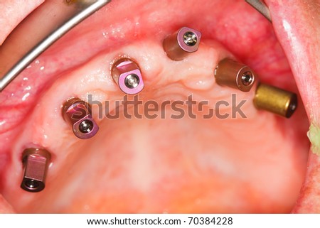 A macro shot of dental implants in the oral cavity (human mouth).