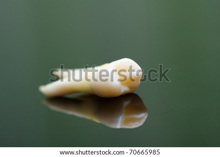 An extracted tooth with visible elements.