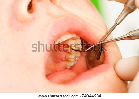 A doctor examining a young patient with a special probe, for approximal (very good hidden) cavities.