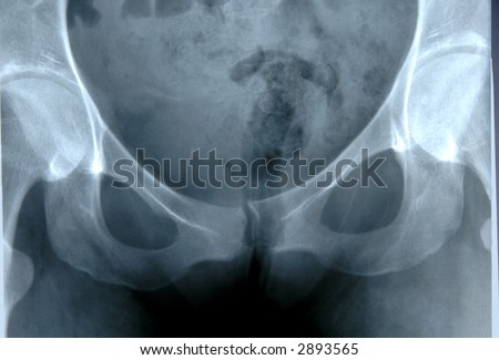 X-Ray of human pelvis showing hip bones and abdominal area.