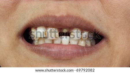 Bad teeth during treat to wait for fasten dentures