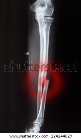 X-ray fracture ulnar bone (forearm bone)