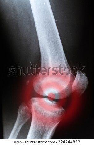 X-ray of a knee, painful X-ray of a knee, painful
